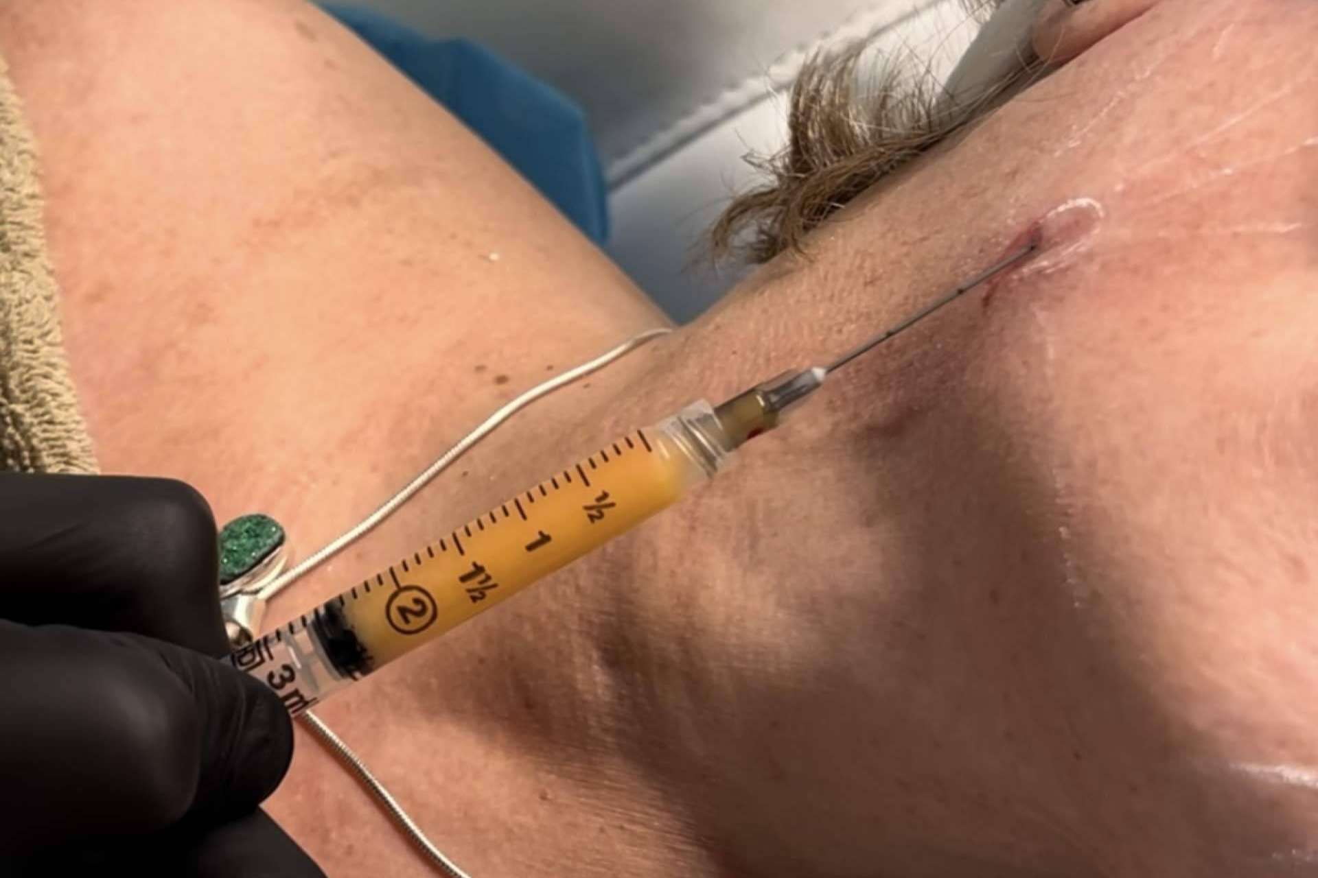 Rejuvenecimiento facial en MD Cliniques; la revolución de SEFFILLER®️ y la regeneración celular autóloga